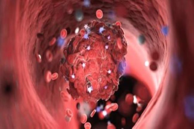 פרדקסה קריש דם